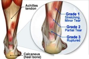 Your Achilles Heel: Tendonitis Prevention and Management