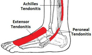 All About Ankle and Foot Tendinitis: A Common Ailment Among Hurdlers