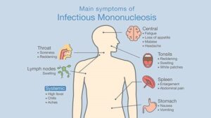 Mononucleosis: Cause, Symptoms, Treatment, and Recovery Time