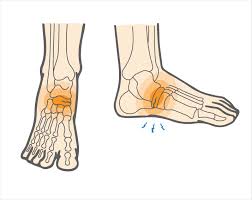 Common Hurdler Injuries: Navicular Stress Fracture