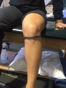 Common Knee Injuries: Iliotibial Band Syndrome, Jumper’s Knee, and ACL Tears