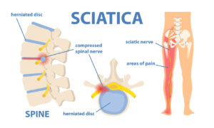 Sciatica: How to Prevent & Treat This Common Injury